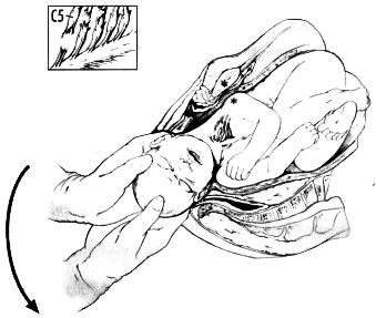 Obstetrisch plexus letsel